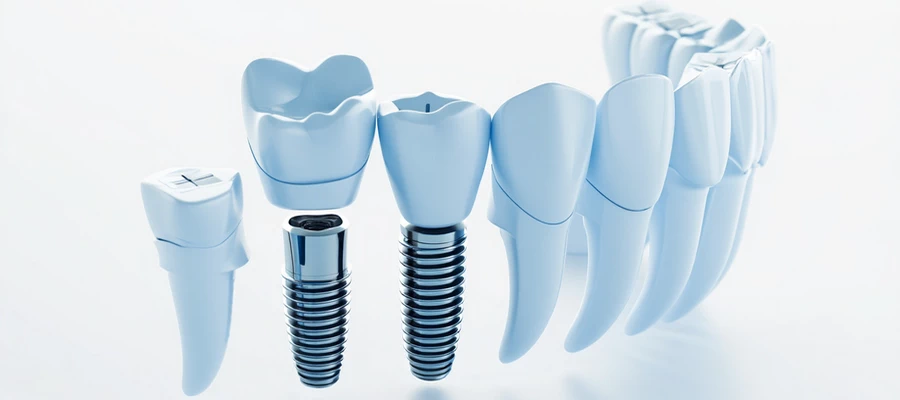 Dental Implants Cost in Fairfax VA