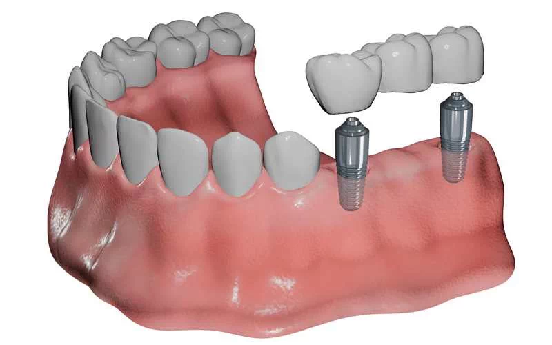 Trusted Dentist in Fairfax - Restorative Dentistry