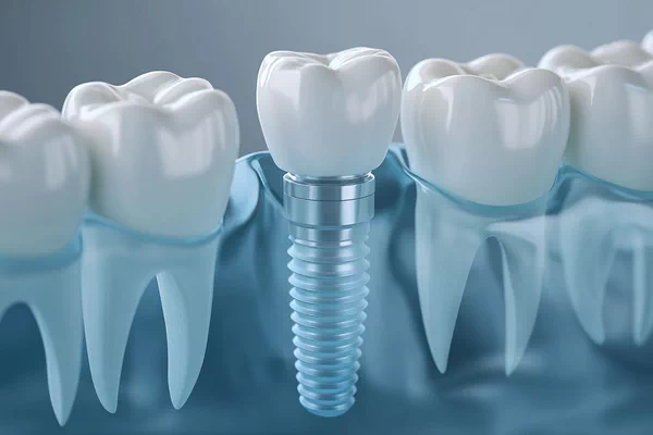 Dental Implants