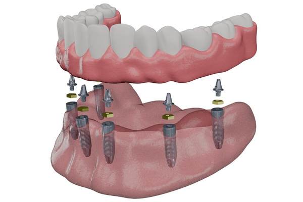 Full Mouth Dental Implants