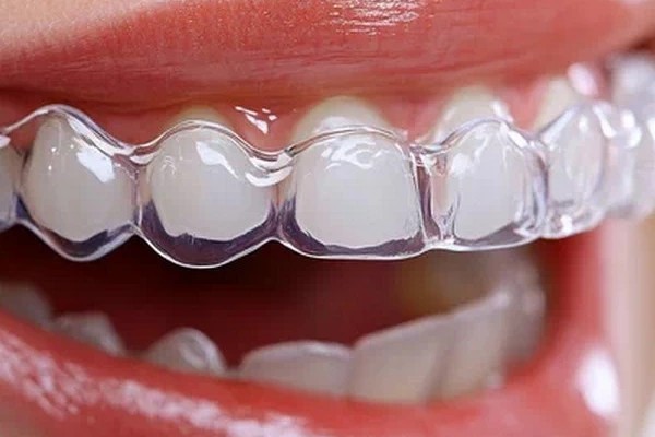 Invisalign